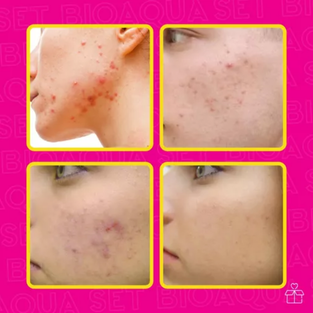 Set De 3 Pure Skin Bioaqua Retira Acne Espinillas Grasa OnlyShop Mexico