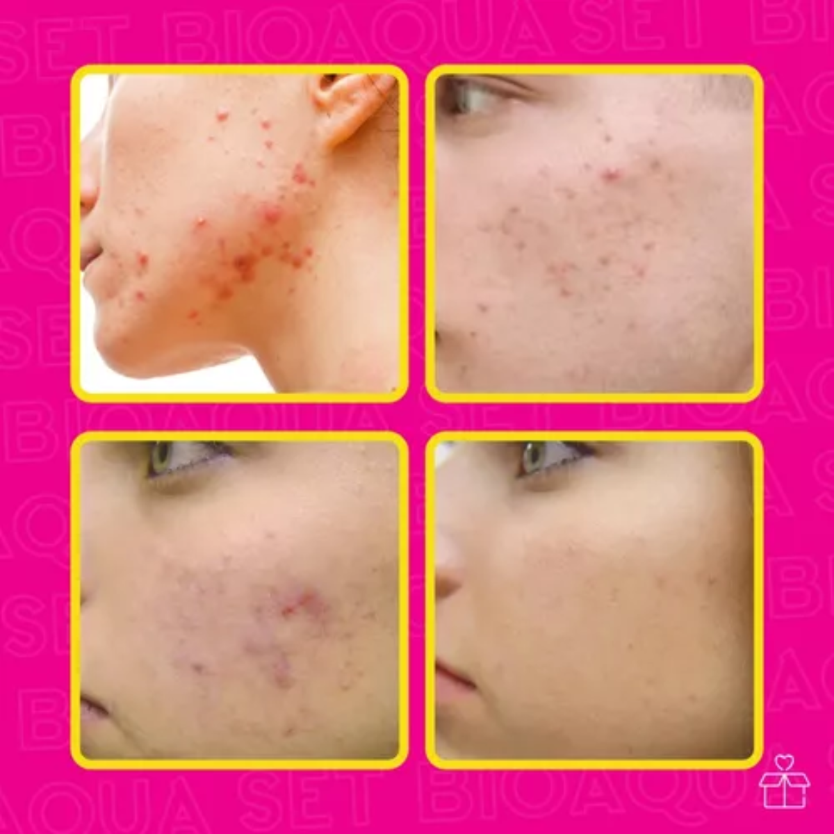 Set De 3 Pure Skin Bioaqua Retira Acne Espinillas Grasa OnlyShop Mexico