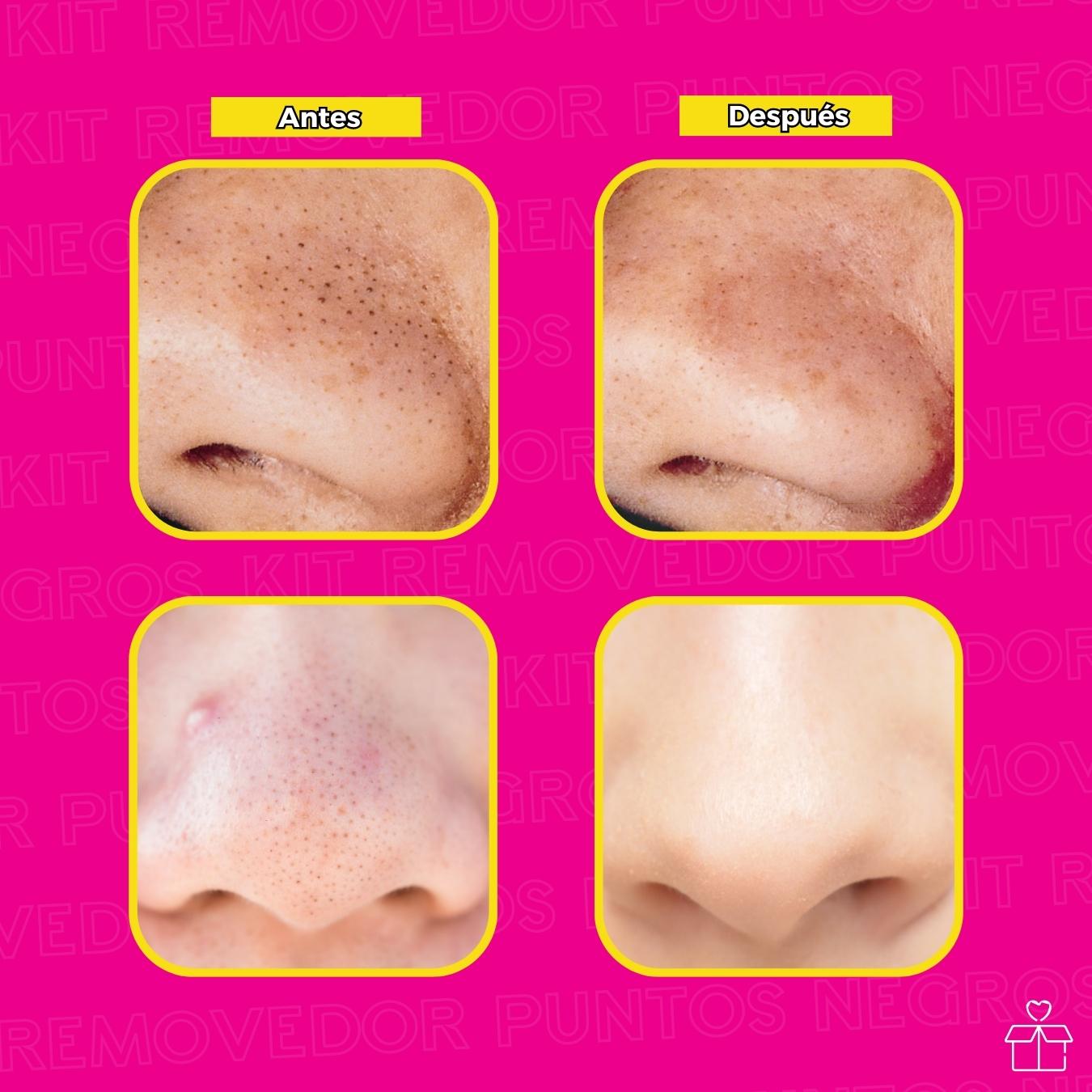 Kit Removedor De Espinillas Anti Acne Puntos Negros 4 Piezas OnlyShop Mexico